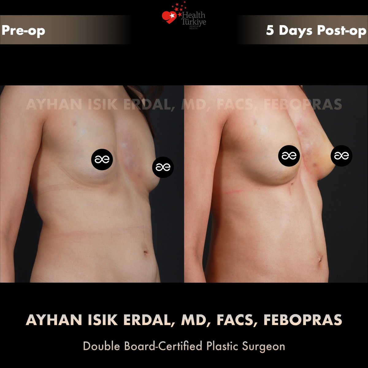 Fat grafting after failed breast surgery — Left oblique, patient of Dr. Ayhan Işık Erdal