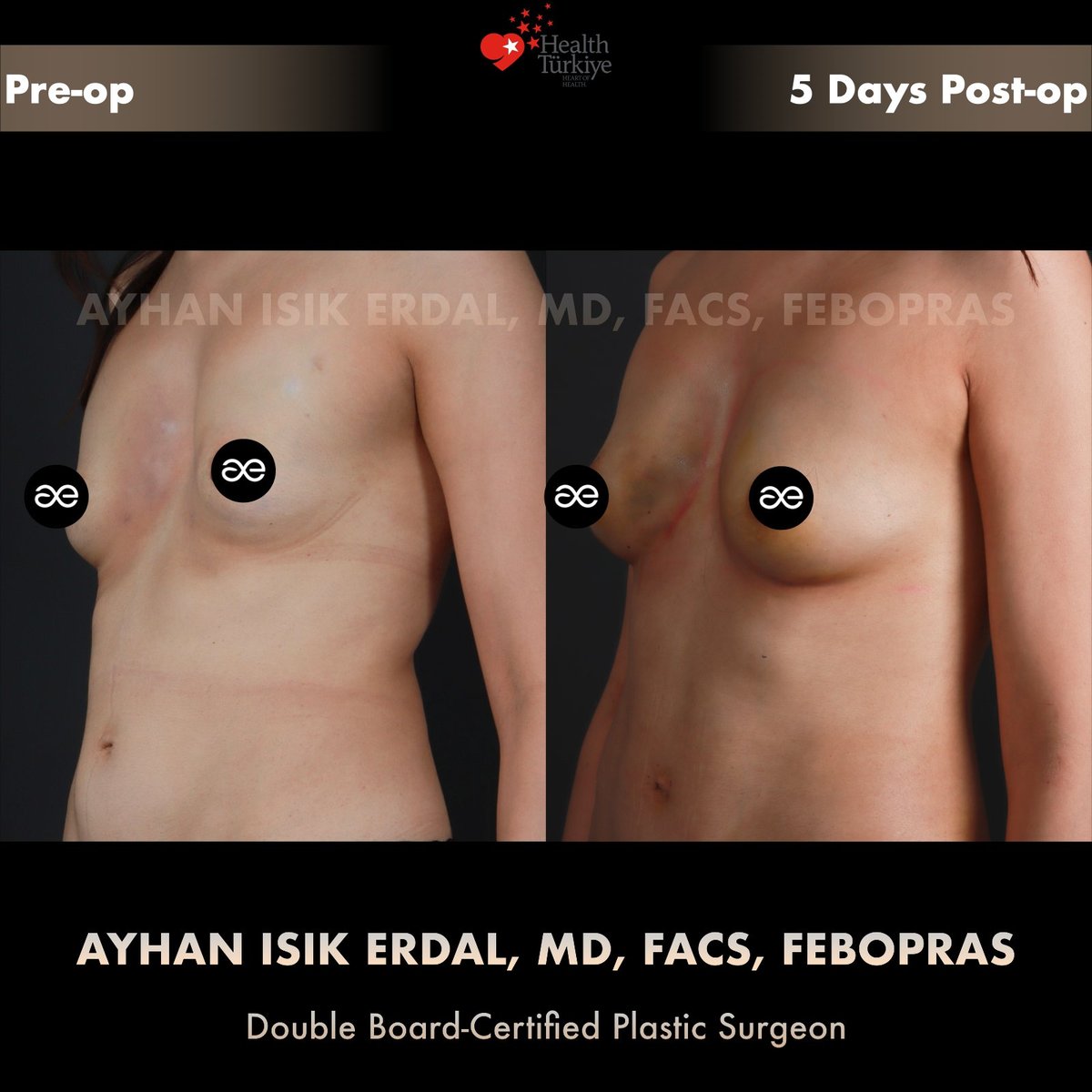 Fat grafting after failed breast surgery — Right oblique, patient of Dr. Ayhan Işık Erdal