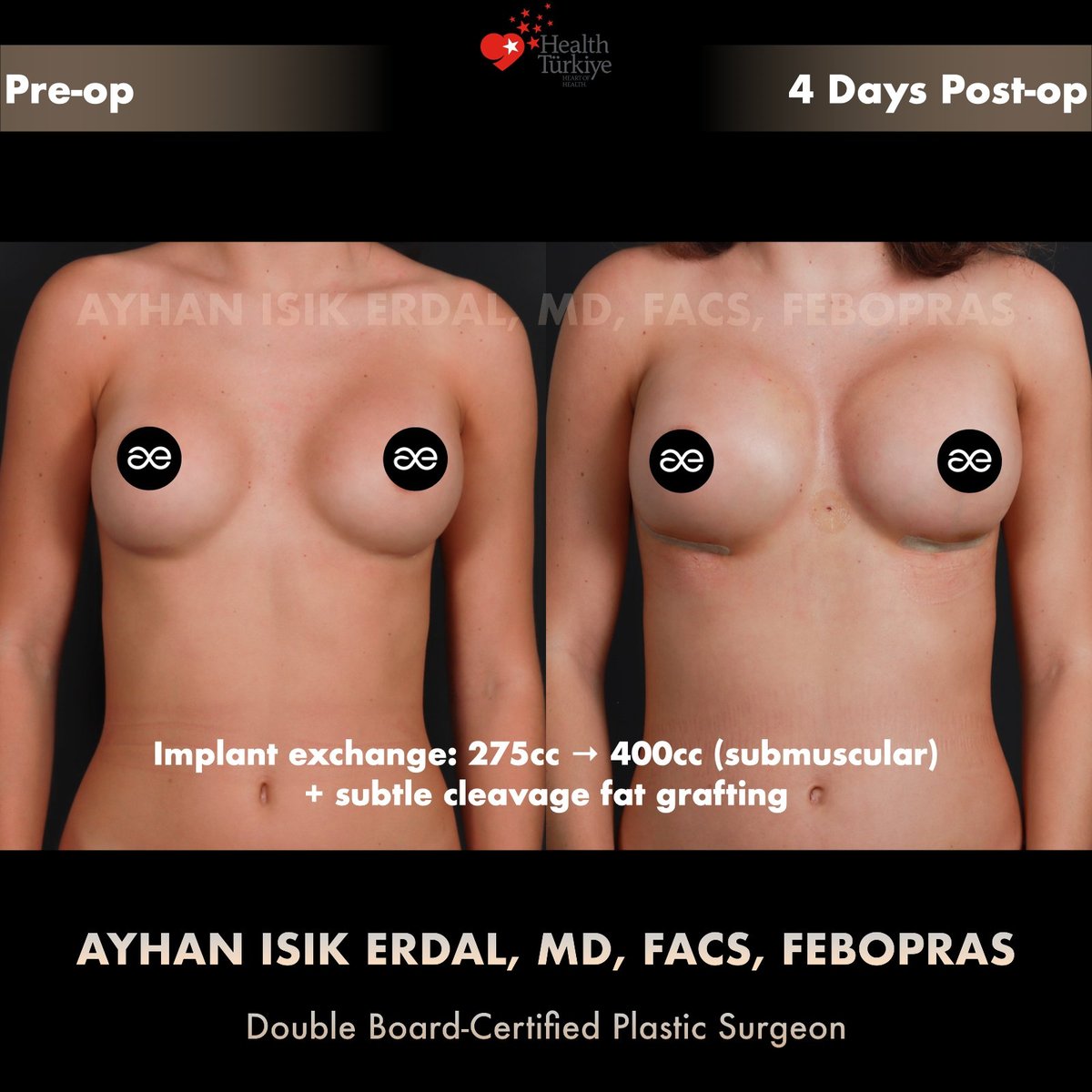 Implant exchange with cleavage fat grafting — Front view, patient of Dr. Ayhan Işık Erdal