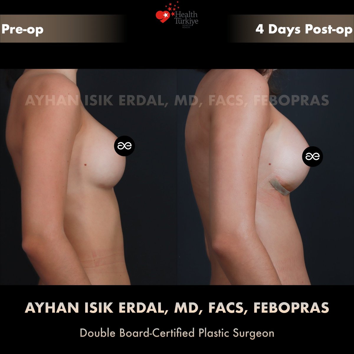 Implant exchange with cleavage fat grafting — Lateral view, patient of Dr. Ayhan Işık Erdal