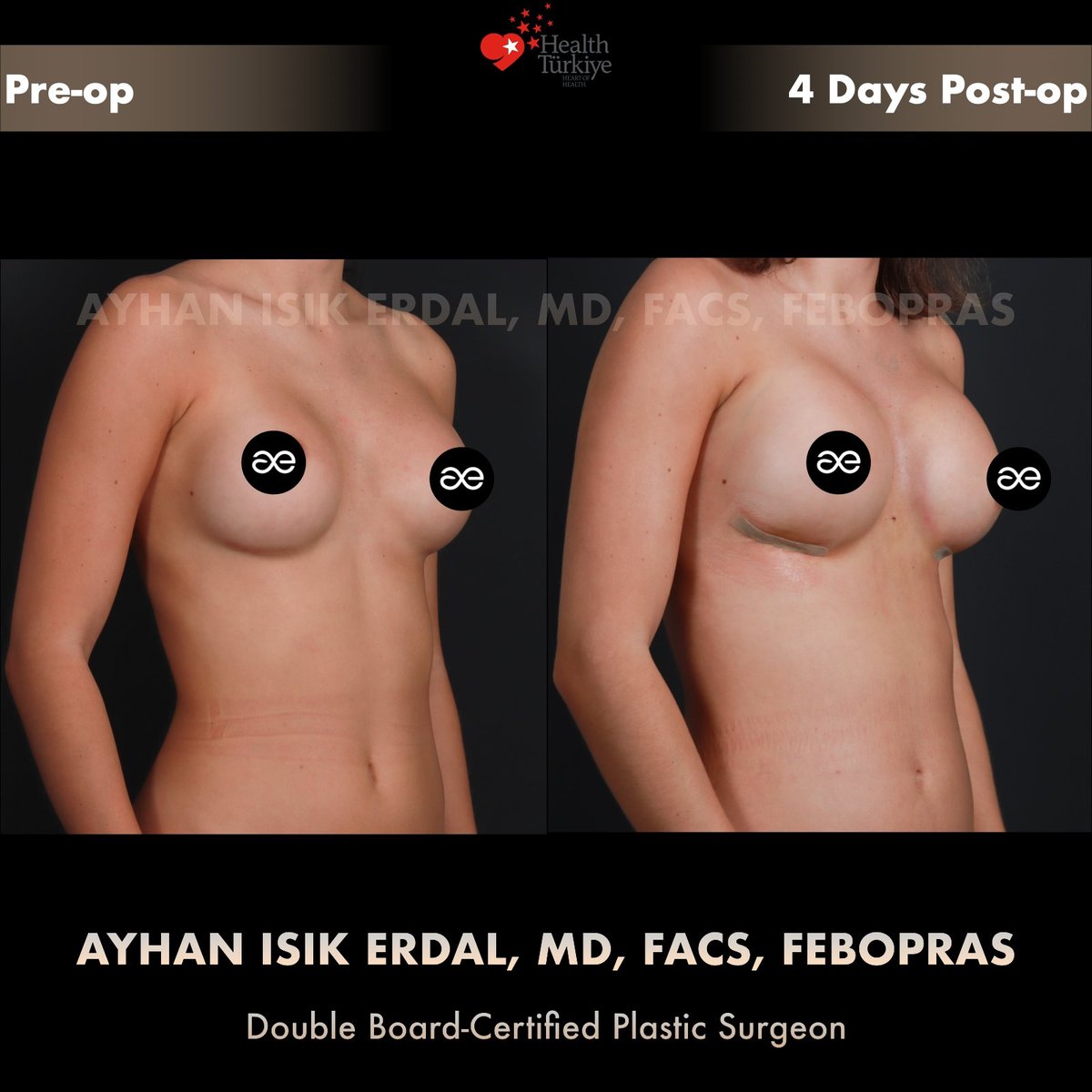 Implant exchange with cleavage fat grafting — Oblique view, patient of Dr. Ayhan Işık Erdal