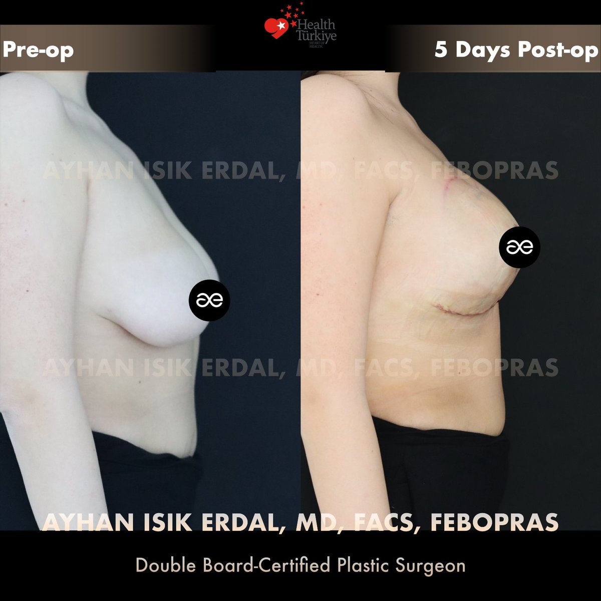 Asymmetric augmentation-mastopexy — Lateral view, patient of Dr. Ayhan Işık Erdal