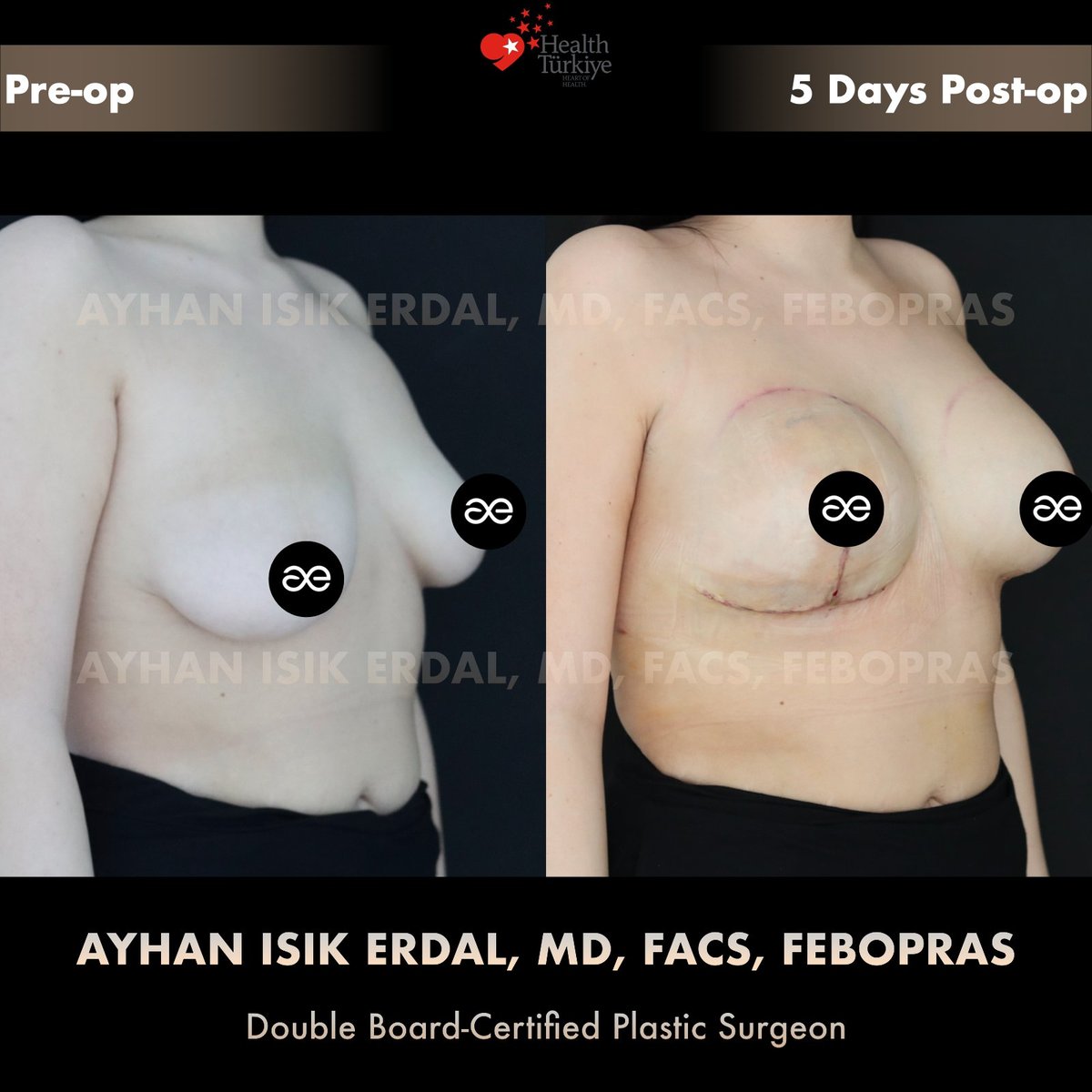 Asymmetric augmentation-mastopexy — Oblique view, patient of Dr. Ayhan Işık Erdal